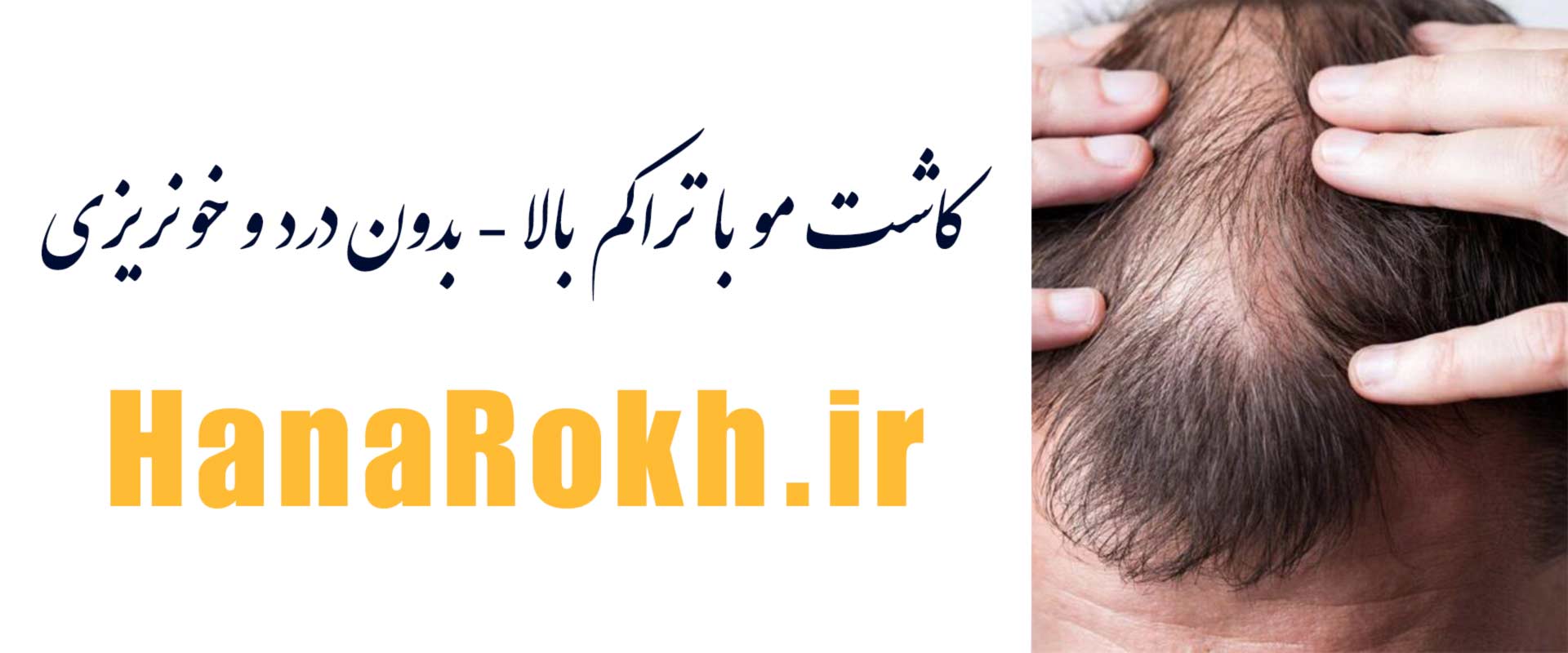 کاشت موی طبیعی